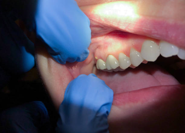 Best Emergency Care for Gum Disease in San Felipe, TX